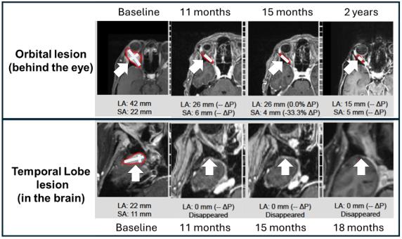 A comparison of mri images

AI-generated content may be incorrect.